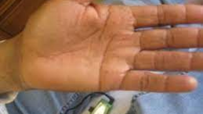 Acupuncture for Stress Relief