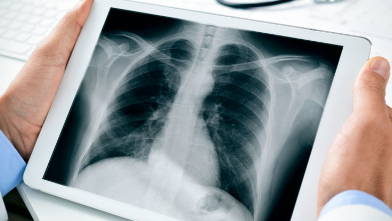 X-Rays Market is Booming Across the Globe by Share, Size, Growth, Segments and Forecast 2030