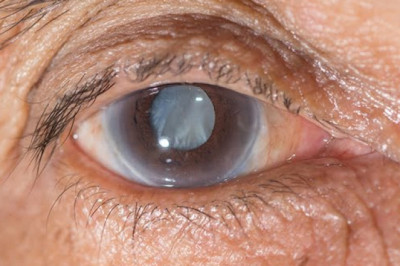 LASIK Surgery | Freedom Eye Laser