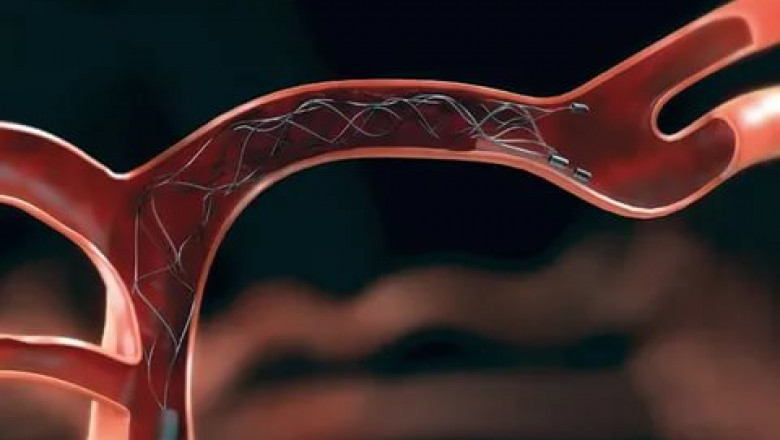 Thrombectomy Devices Market - Opportunities, Share, Growth and Competitive Analysis