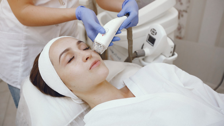 microneedling with radiofrequency