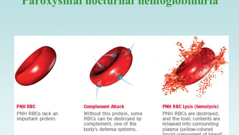 The Paroxysmal Nocturnal Hemoglobinuria Therapeutics reduces the risk of blood clotting and improves the quality of life of those suffering from PNH.