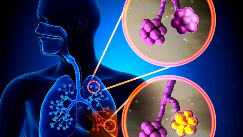 Global Pneumonia Testing Market: Trends, Size, Growth, Opportunity, and Forecast to 2022-2028
