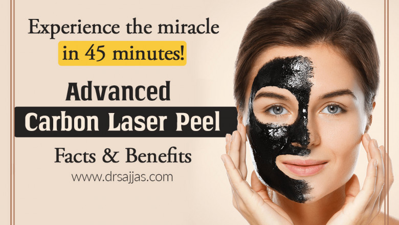 How is Carbon peel treatment works?