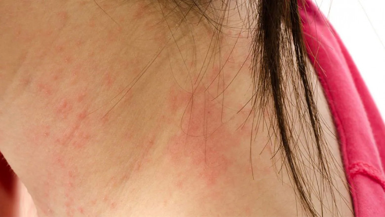 Skin Vesicles: Causes, Symptoms, Prevention & Treatment