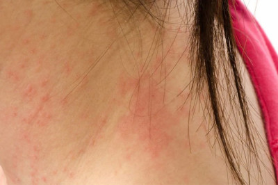 Skin Vesicles: Causes, Symptoms, Prevention & Treatment