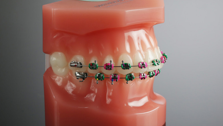 What Are The Best Colors For Dental Braces?