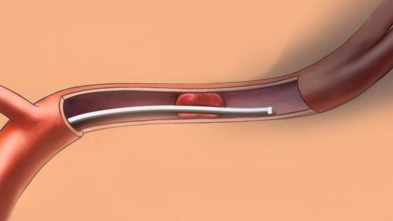 A study of the global Clot Management Devices Market: trends, market size, growth, opportunity, as well as forecasts for 2022-2028