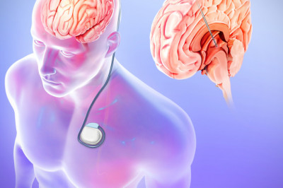 A study of the global Vagus Nerve Stimulators Market: trends, market size, growth, opportunity, as well as forecasts for 2022-2030