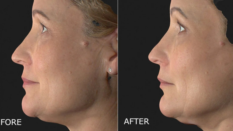 Understanding the multifaceted aspects and perks of opting for laser hair removal