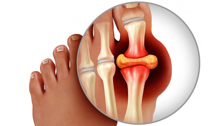 Gout Therapeutics Market Size, Share, Regional Overview and Global Forecast to 2028