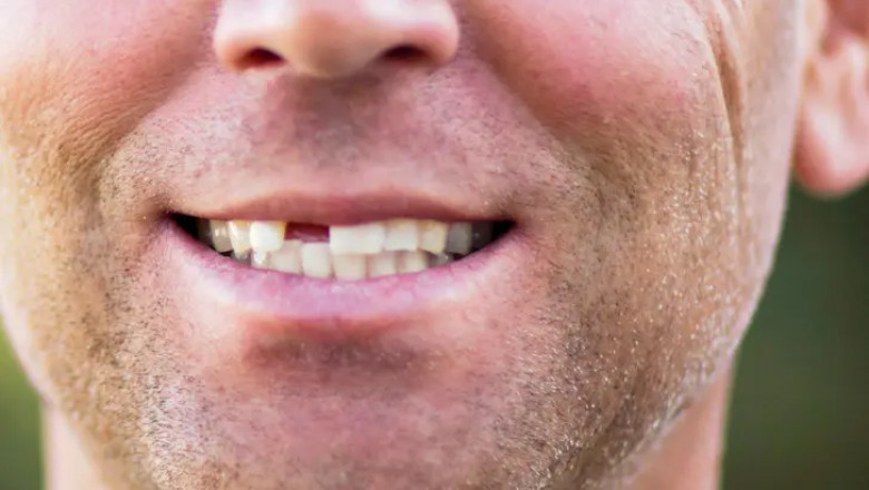 Full-Mouth Restoration Options for Lasting Oral Health