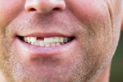 Full-Mouth Restoration Options for Lasting Oral Health