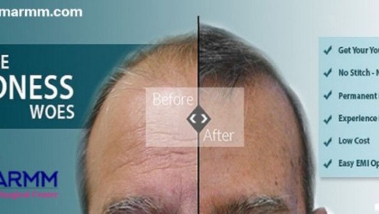 How Do Hair Specialists Fulfill the Requirement of Hairs in Hair Transplant?