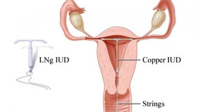 Endometriosis and Mirena Is it the proper Treatment for You?