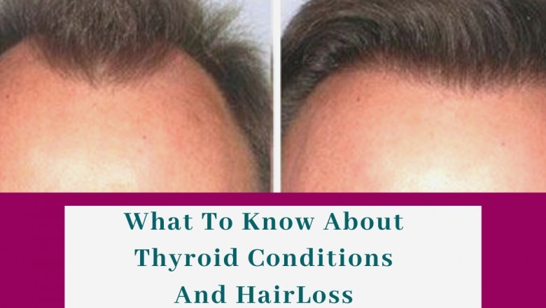What To Know About Thyroid Conditions And HairLoss