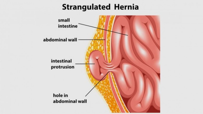 Achalasia Cardia Treatment & Surgery in Ahmedabad, Gujarat, India