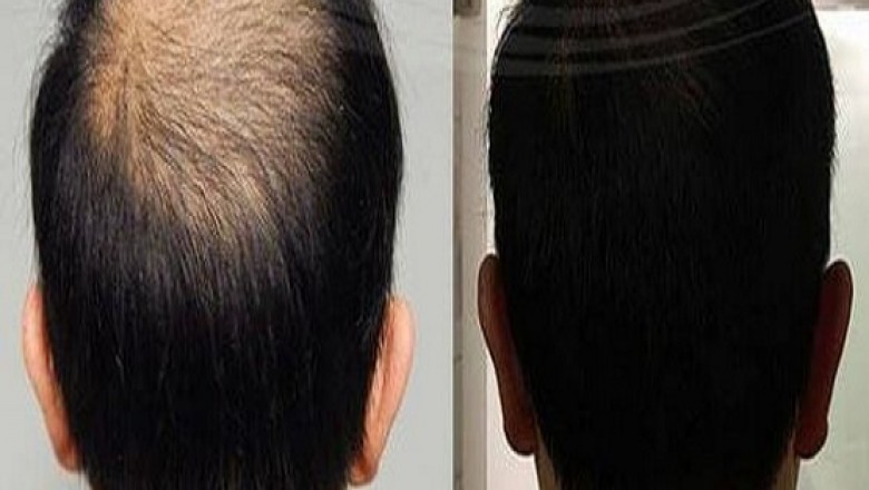 Best Hair Fixing in Bangalore