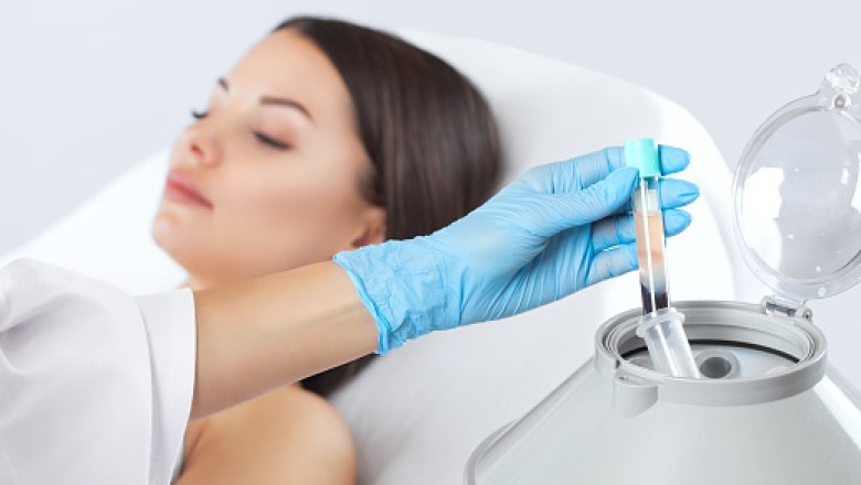 PRP Hair Loss Treatment London