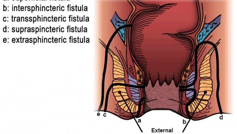 Fistula hospital Ahmedabad