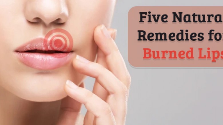 Five Natural Remedies for Burned Lips