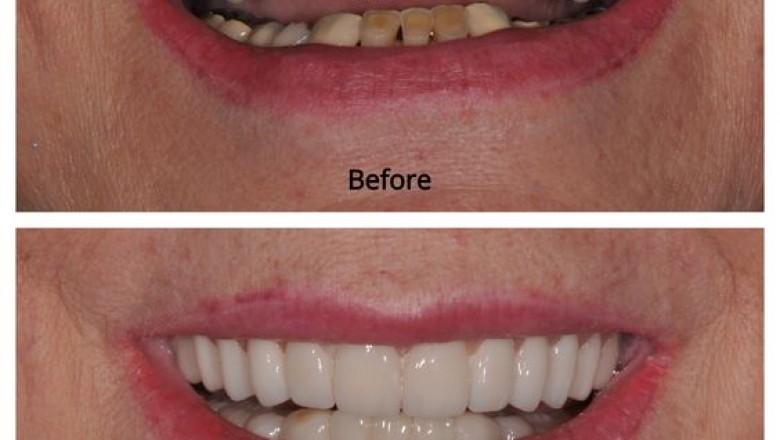 Reasons Why Dental Implants Are Constantly Gaining In Popularity