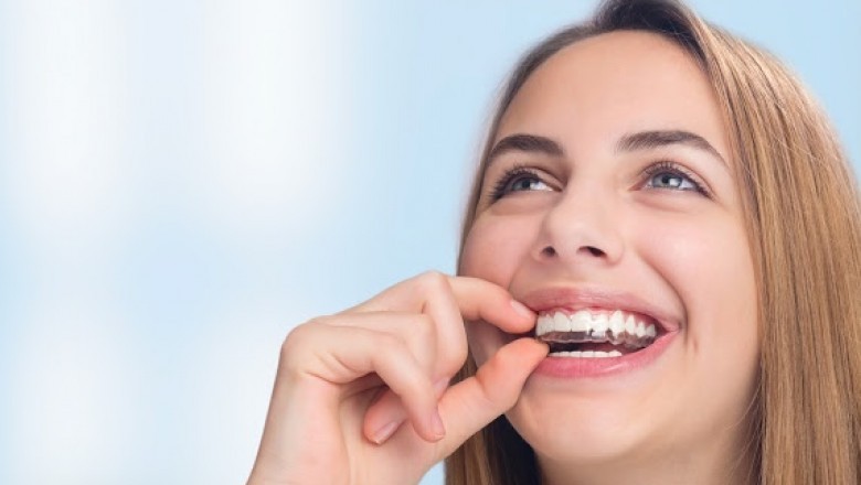 10 Advantages of Invisalign