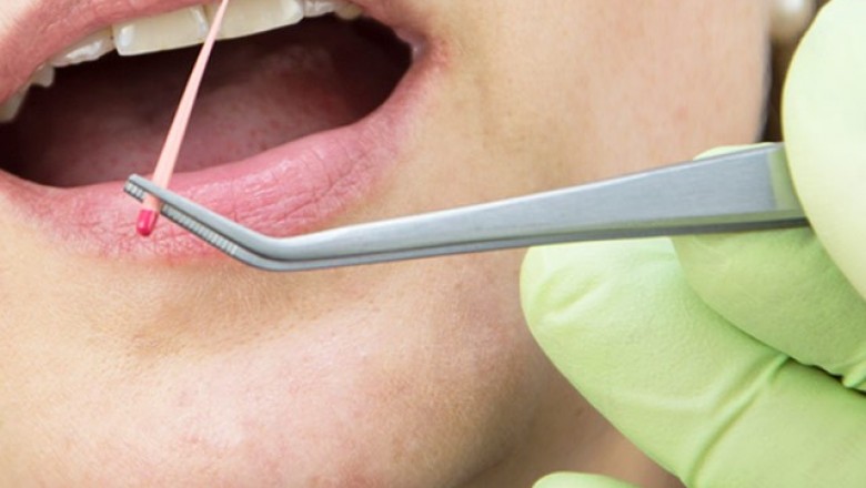 Endodontic Consumables Market Clinical Research Analysis 2020 to 2030