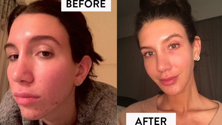 5 top Supplements for hormonal acne