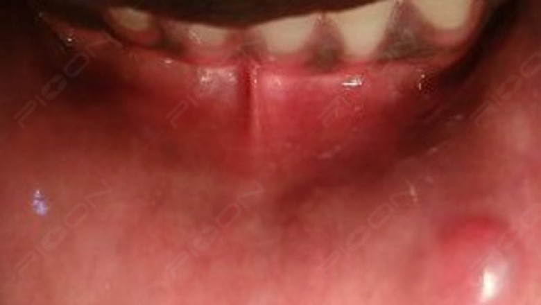 Excision of Fibroma using Dental Soft-tissue Diode Laser