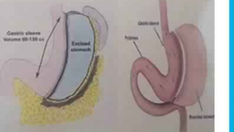 Laparoscopic Obesity or Bariatric/ Weight Loss Surgery & Treatment