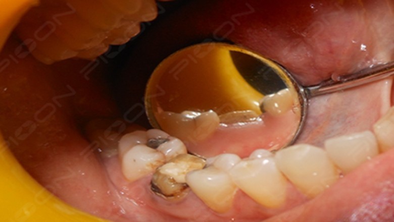 Crown Lengthening Procedure using Dental Diode Laser