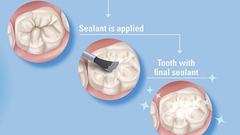 Dental Sealants : Are They Useful in Reality?
