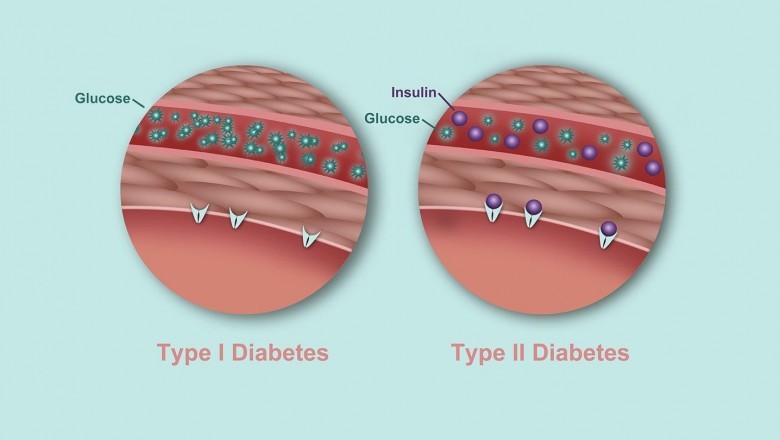 Type 1 Diabetes vs Type 2 Diabetes