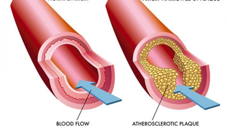 Atherosclerosis Treatment Drugs Market Analysis-2027
