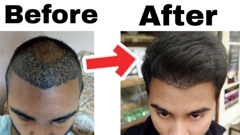 Best Hair Transplant in Delhi - Chandra Clinic