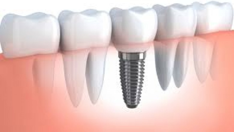 Dental Implants Toronto