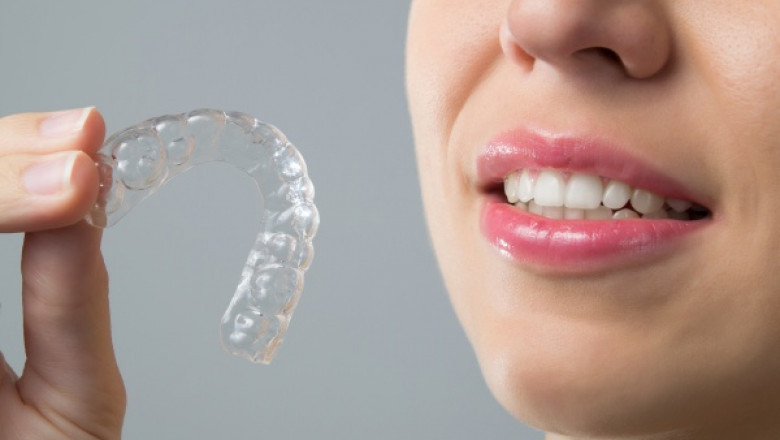 Ask These Invisalign Questions To Your Orthodontist