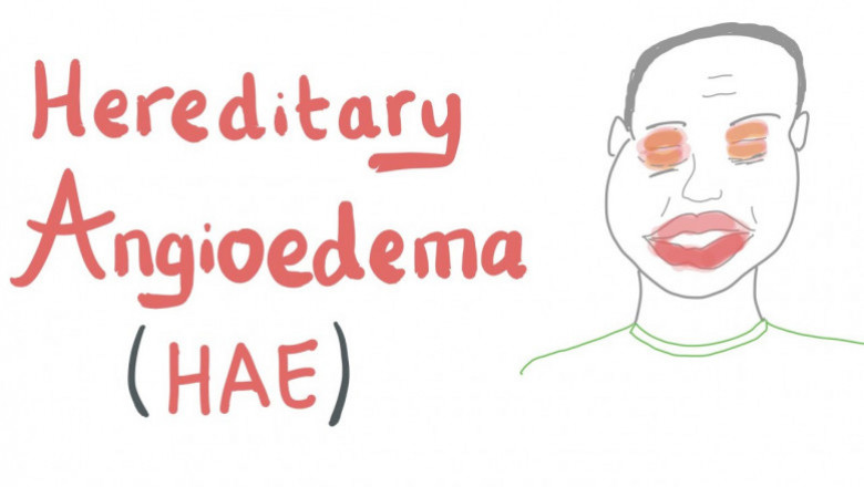 Hereditary Angioedema Market Beyond US$ 3.4 Billion By 2025 - Coherent Market Insights