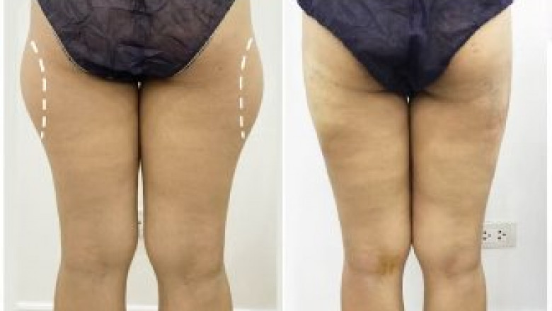VASER Liposelection - The subsequent Gen in Physique Contouring