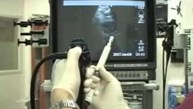 Endobronchial ultrasound biopsy is used to identify other diseases such as tuberculosis and chronic pulmonary obstructive disorder