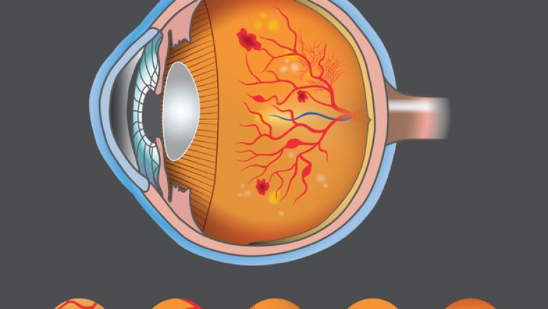 Adults Suffering From Diabetes Also Have Proliferative Diabetic Retinopathy (Pdr), Which Is Characterized By Neovascularization Of Retina