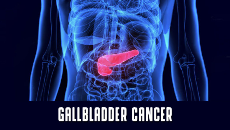 What is Gallbladder Cancer | Gallbladder Stone Treatment in Gurugram, Gurgaon, Delhi, India