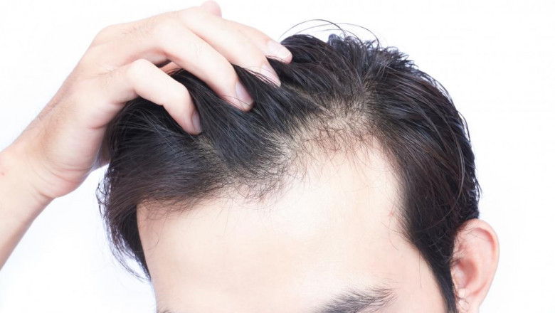 Does PRP Treatment Work For Hair Loss And Is It Safe?