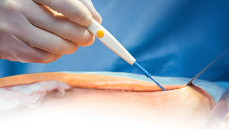 Electrosurgery Is an Advanced Medical Technique Used For Healing, Human Tissues by Passing High-Frequency Alternating Polarity in the Body
