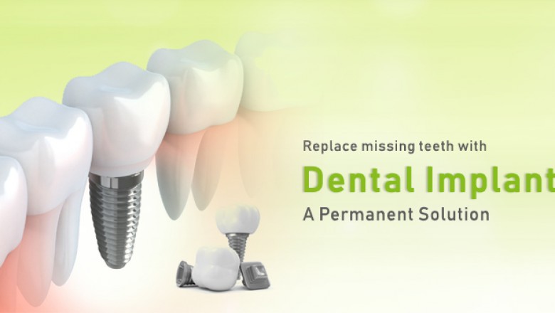 Dental Implants - What You Need to Know?