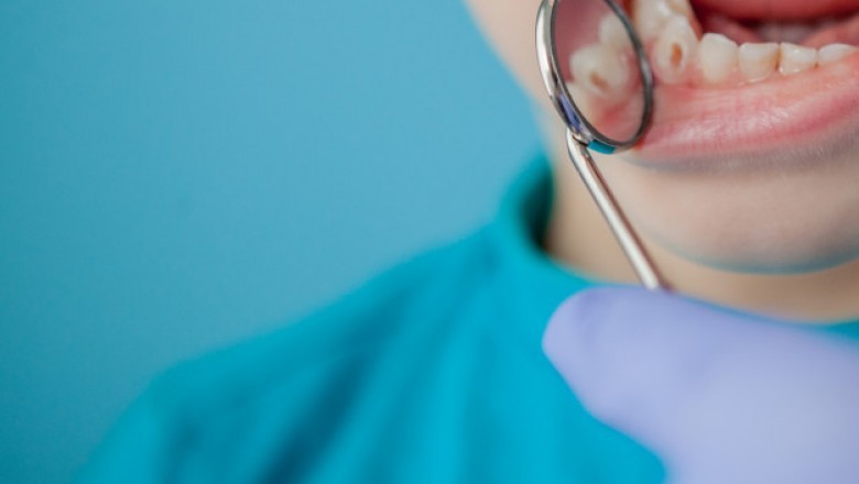 The introduction of advanced medical procedures such as dental fillings, dental caries treatment options have improved throughout time