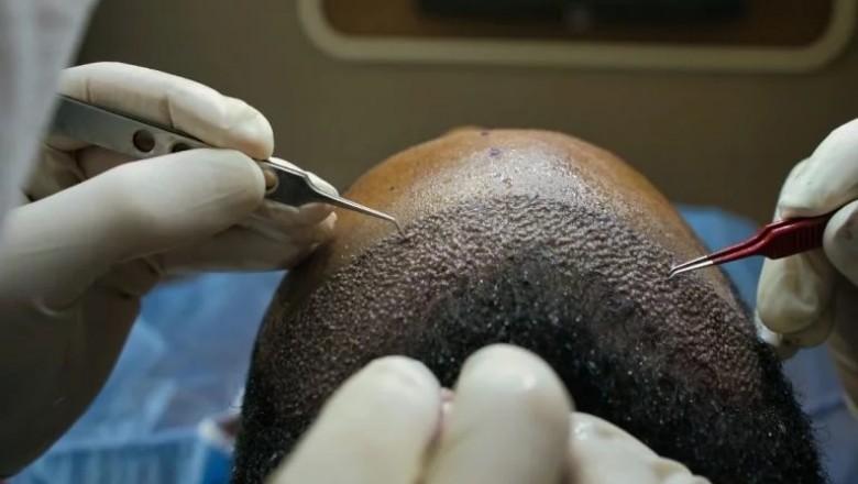 What Can Go Wrong With Hair Transplant?