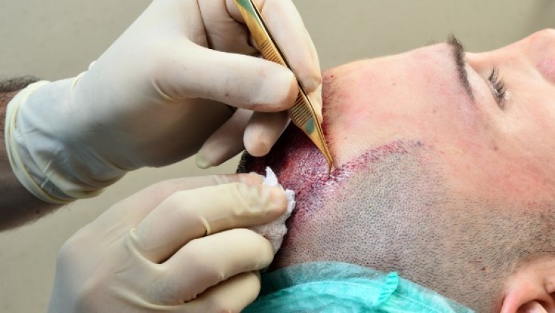 Would you get a Hair Transplant Procedure for a Burn Scar?