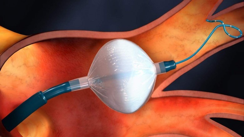 Cryoablation devices use extreme cold to shrink tumours as part of cancer treatment